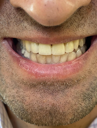 Replaced 7-10 with layered zirconia crowns photo 2