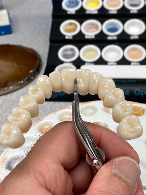 Stain and glazed monolithic zirconia bridge photo 2