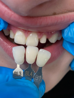 Tooth-Photo-Reference-3