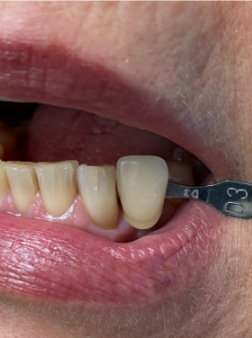 Tooth-photo-reference-1