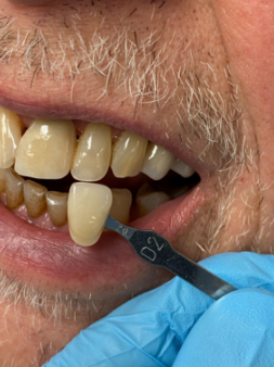 Tooth-photo-reference-2